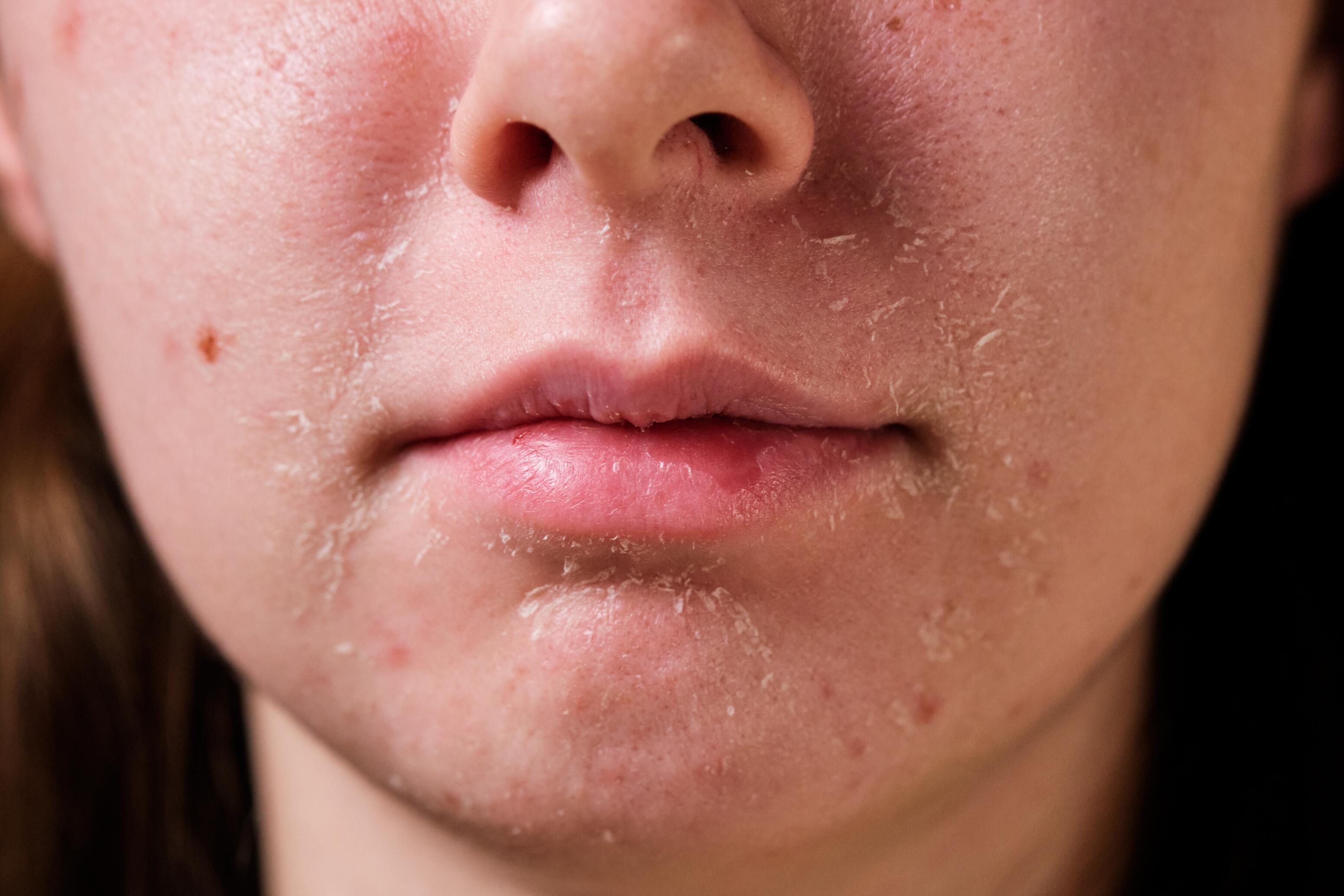 Dermite séborrhéique sur les cheveux